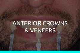 Anterior Crowns & Veneers