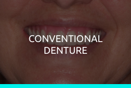Conventional Denture