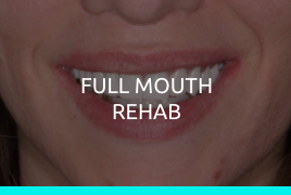Full Mouth Rehab