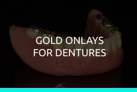 Gold Onlays For Dentures