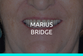 Marius Bridge