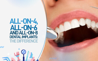 All-On-4, All-On-6, And All-On-8 dental Implants: The Difference