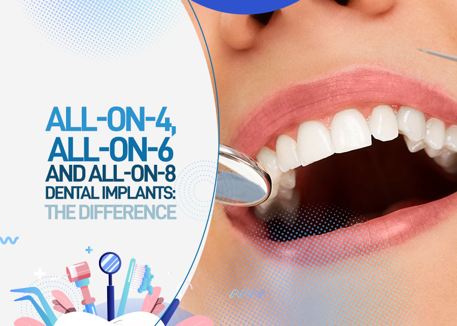 All-On-4, All-On-6, And All-On-8 dental Implants: The Difference