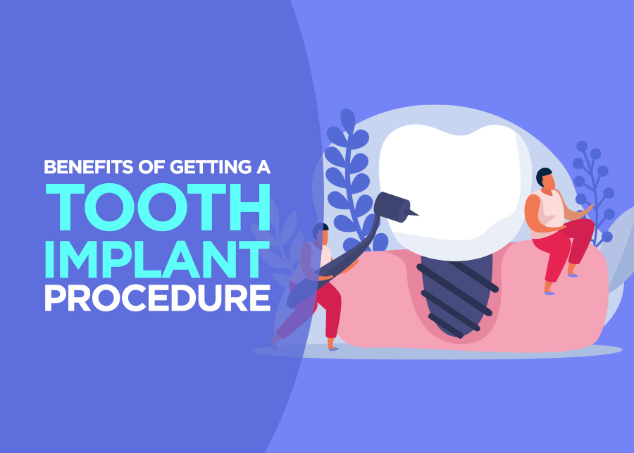 Benefits of Getting a Tooth Implant Procedure