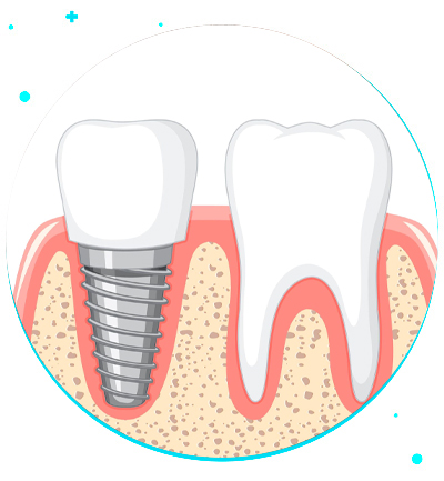 A Guide to All-On-4 Dental Implants Aftercare