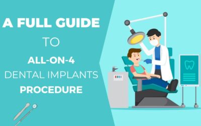 A Full Guide to All-On-4 Dental Implants Procedure