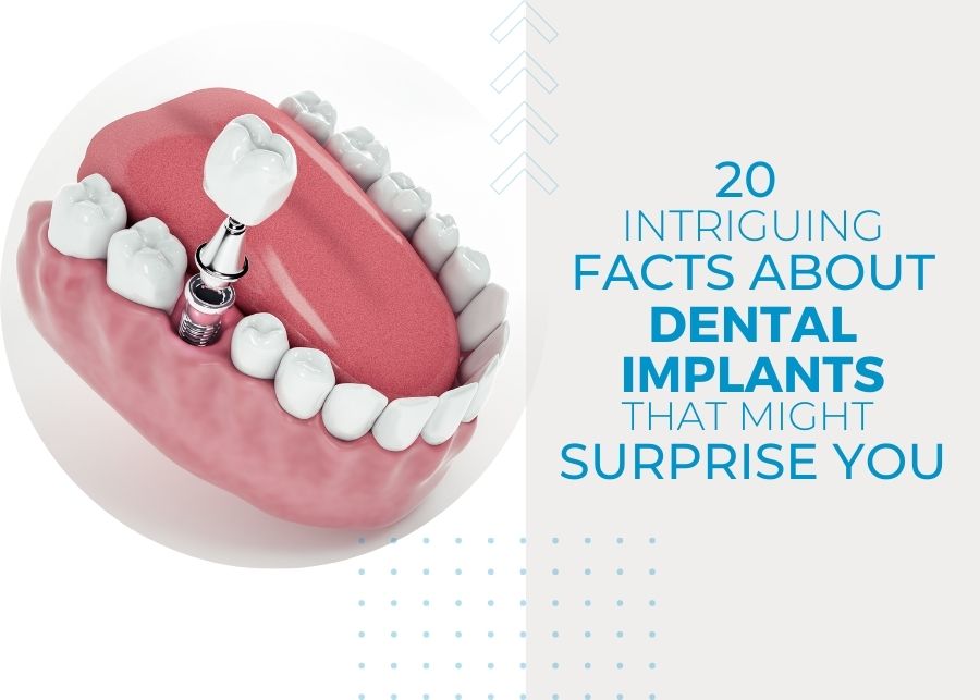 20 Intriguing Facts About Dental Implants That Might Surprise You