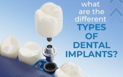 What are the Different Types of Dental Implants?
