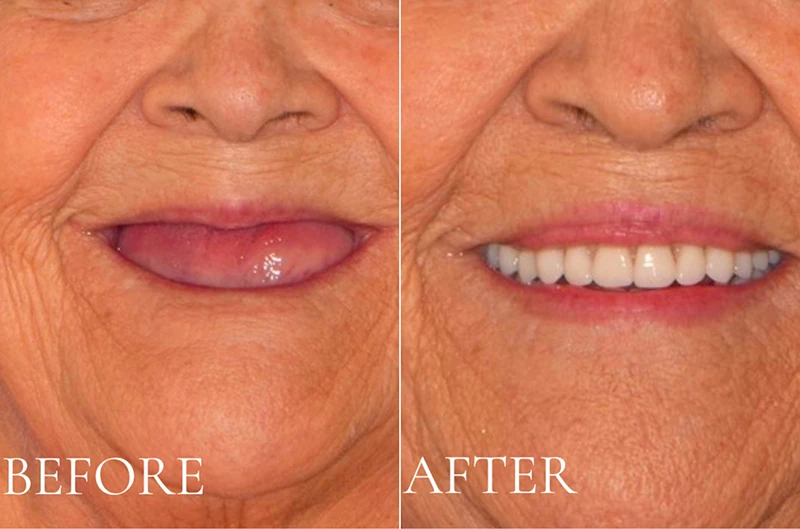 Before and after comparison showing an elderly patient with no teeth transformed to smiling with full white dentures