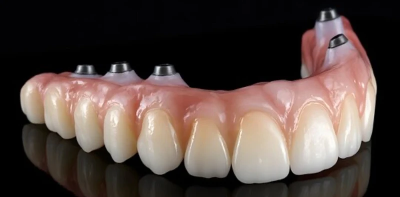 Dental implant prosthesis case from Parker Dental Implant and Specialty Center