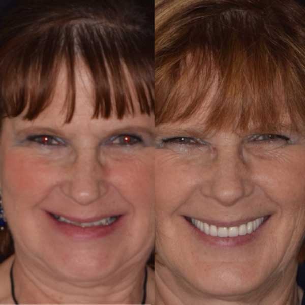 Before and after smile comparison of a full mouth restoration patient at Parker Dental Implant and Specialty Center Before and after smile comparison of a full mouth restoration patient at Parker Dental Implant and Specialty Center