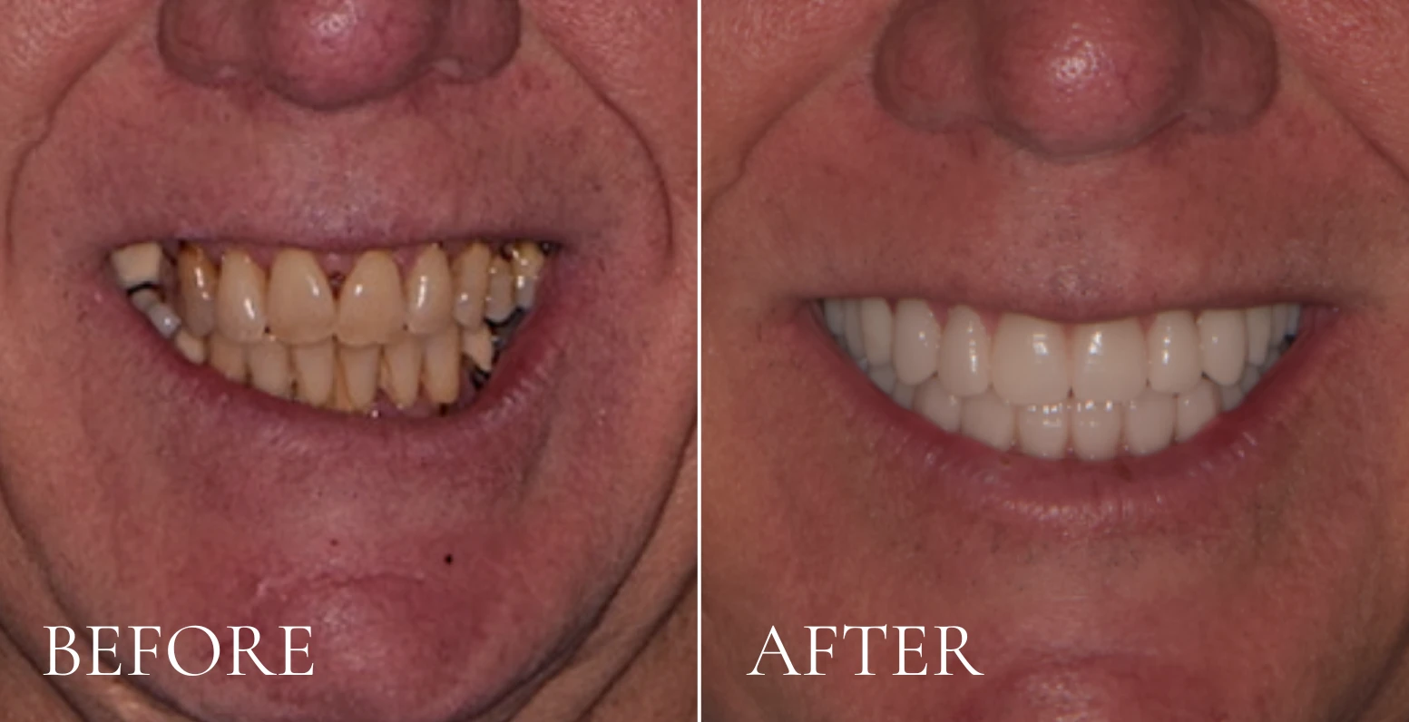 Before and after photo of a man's smile, showing improved, even teeth.