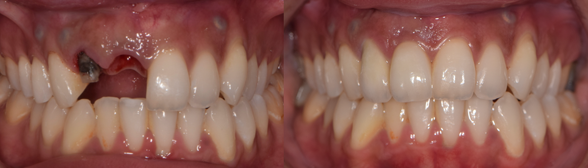 Before and after comparison of tooth-colored composite restoration