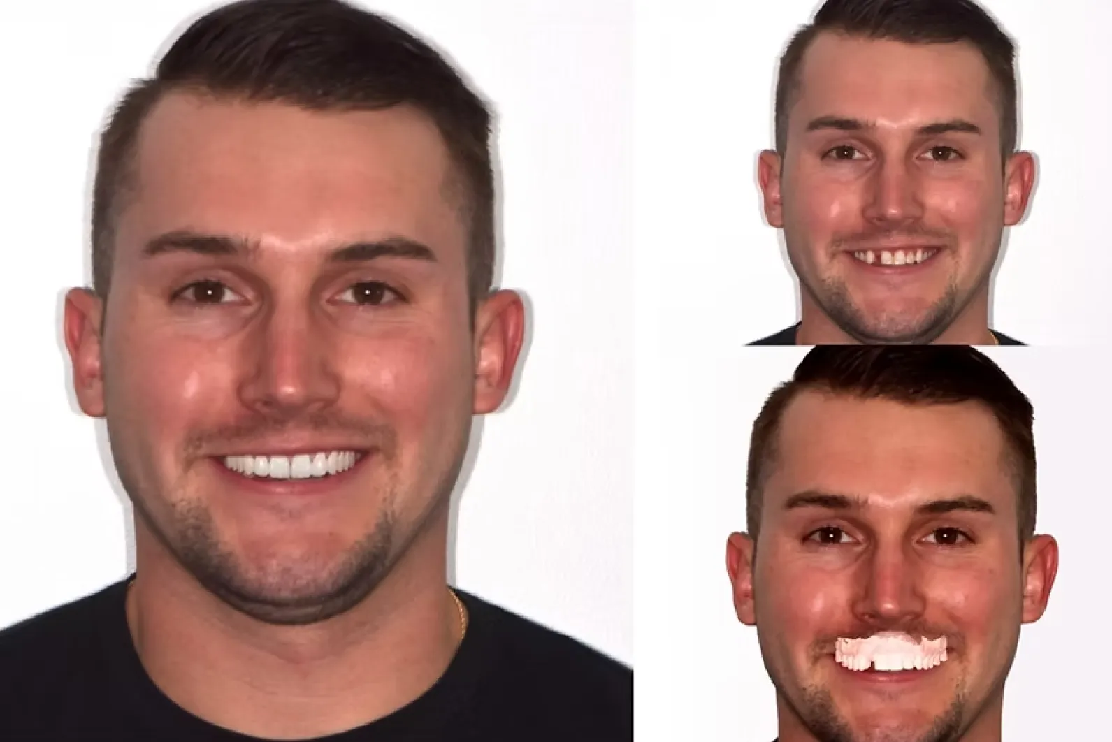 Digital smile design visualization for planning cosmetic dental treatment Digital smile design visualization for planning cosmetic dental treatment
