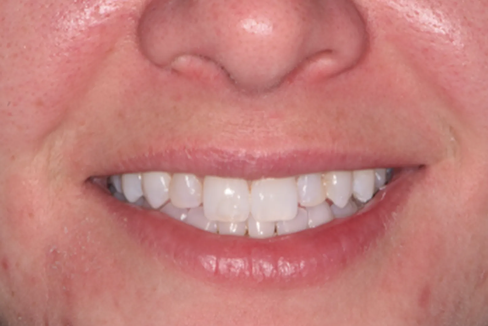 Side-by-side comparison of ceramic veneers and composite veneers on teeth