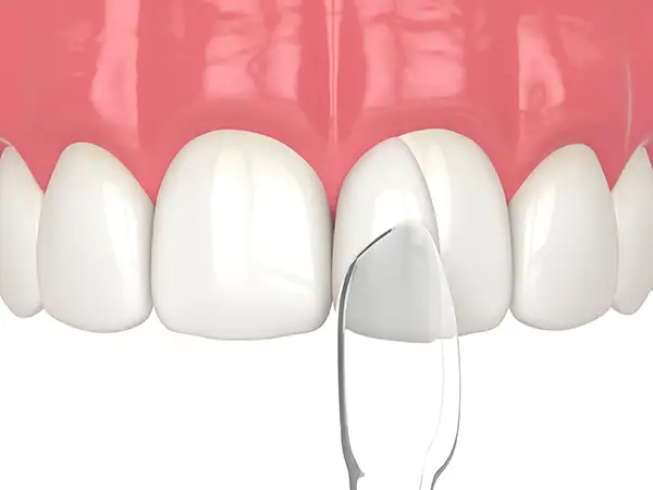 Dental bonding procedure applying composite resin to repair a chipped tooth Dental bonding procedure applying composite resin to repair a chipped tooth