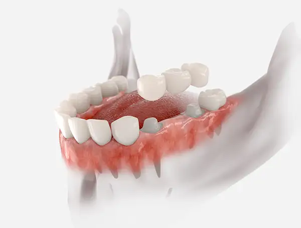 Anterior dental bridge restoration replacing missing front teeth