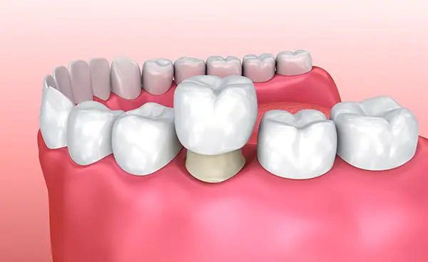 Dental crown placed on a prepared anterior tooth for natural-looking restoration Dental crown placed on a prepared anterior tooth for natural-looking restoration
