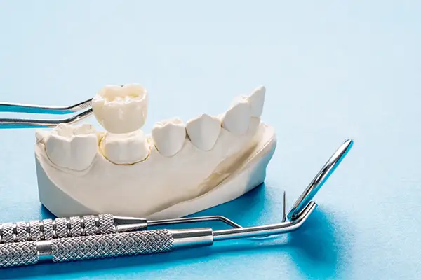 Porcelain dental crown matched to the natural color of surrounding teeth Porcelain dental crown matched to the natural color of surrounding teeth