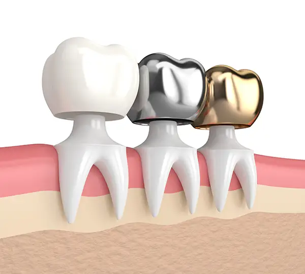 Traditional dental crown being fitted onto a prepared natural tooth