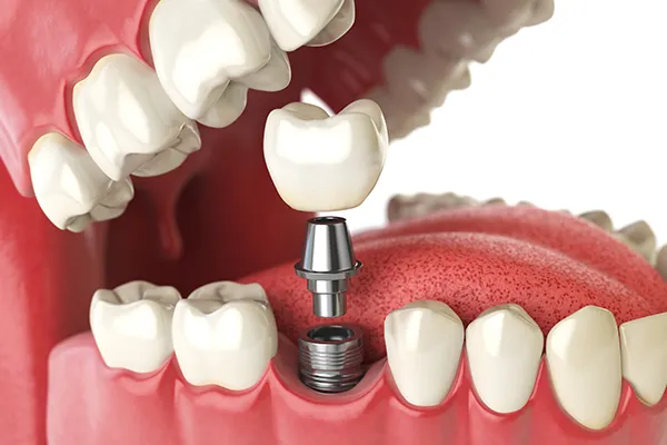 Detailed dental implant diagram showing the post, abutment, and crown components in a jaw model