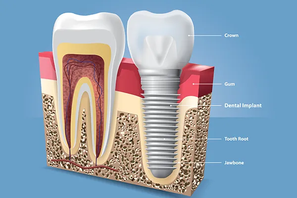 Dental implant model used for patient education about the implant procedure