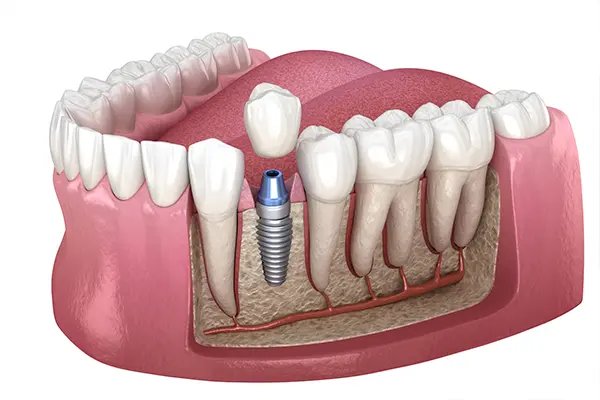 Dental implant restoration showing crown being placed on an implant abutment