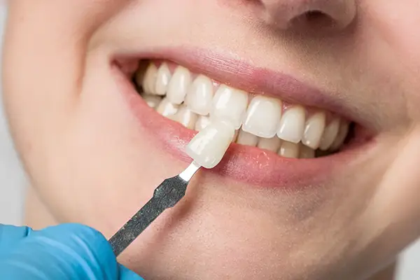 Ceramic dental veneers applied to front teeth for an improved smile Ceramic dental veneers applied to front teeth for an improved smile