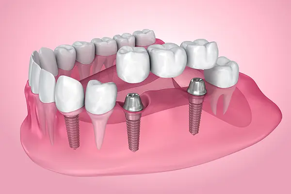 Partial fixed dental bridge replacing several missing teeth