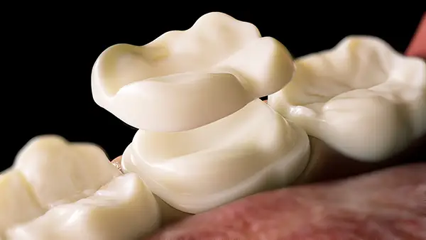 Dental inlay and onlay restorations for preserving natural tooth structure
