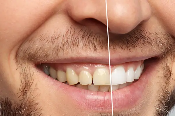 Professional teeth whitening treatment brightening a patient smile Professional teeth whitening treatment brightening a patient smile