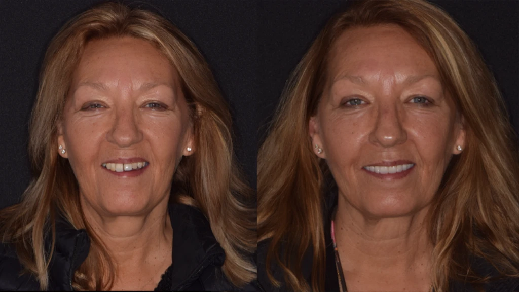 Before and after smile of a patient at Parkway Dental Implant and Speciality Center Before and after smile of a patient at Parker Dental Implant and Speciality Center