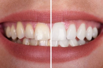 Want a Brighter Smile? Here’s What to Know Before Whitening Your Teeth