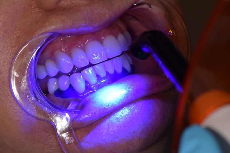 teeth-whitening-picture
