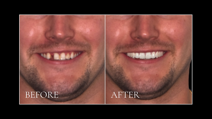 teeth-before-after