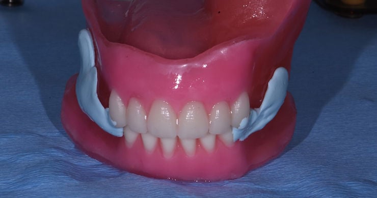 Maxillofacial-prosthetics