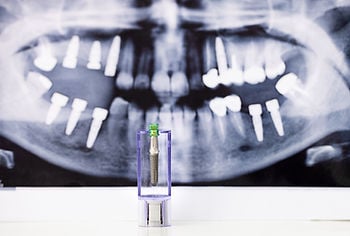 Digital Dental Impression picture