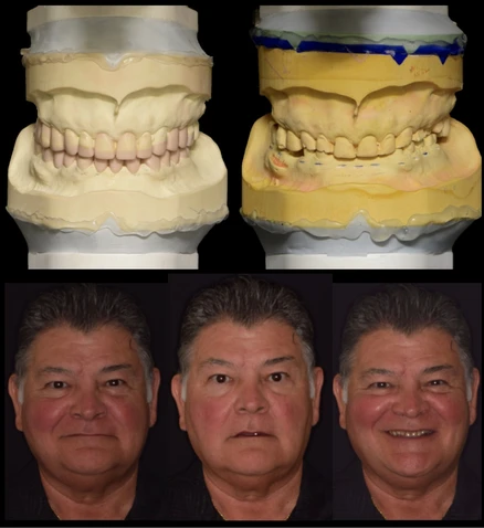 Before and after smile