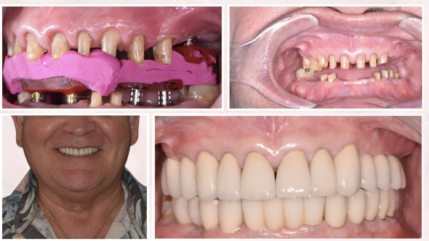 Dental transformation collage: upper images show worn teeth and pink mold application. Lower images reveal complete, bright dentures.