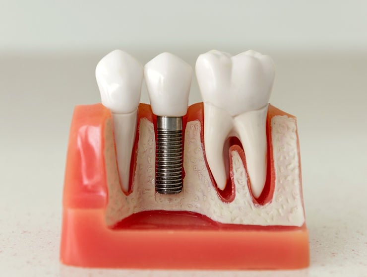 Dental Implant model