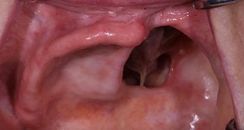 Maxillofacial-prosthetics