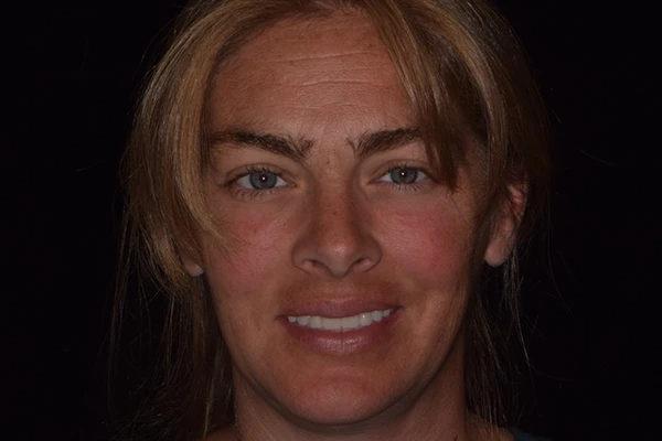 Allon4-After-2 All on 4 after image for a woman with beautiful smile
