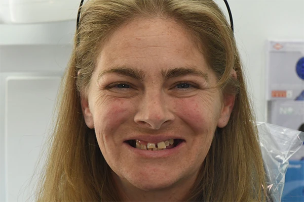 Allon4-Before-2 All on 4 Before image for a woman with crooked teeth