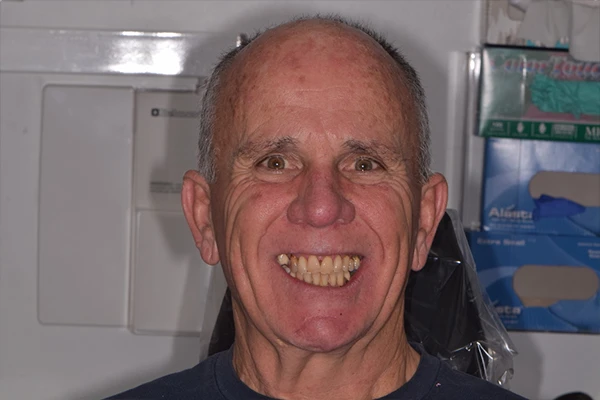 Allon4-Before-Mark1 Before implant smile