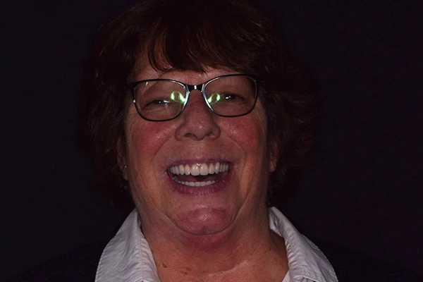 Denture1-after After denture smile