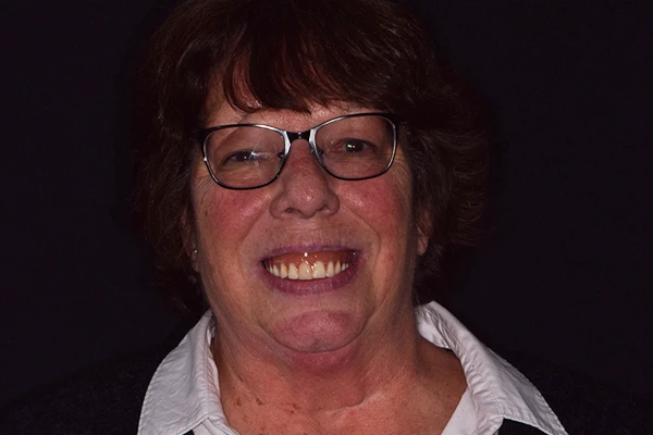 Denture1-before Before denture smile