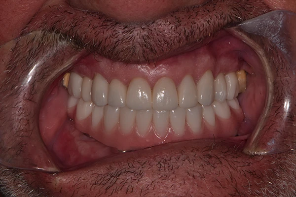 FMR-Allon4-After Before Full mouth rehabilitation
