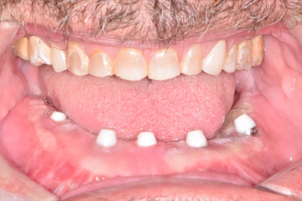 FMR-Allon4-Before1 Before Full mouth rehabilitation
