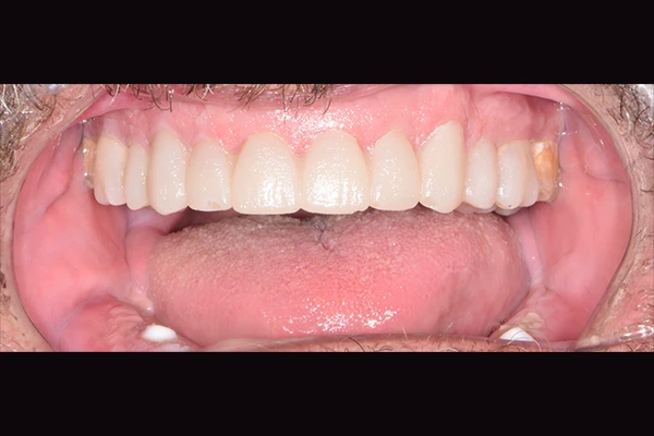 FMR-Allon4-Before3 Intermediate Full mouth rehabilitation