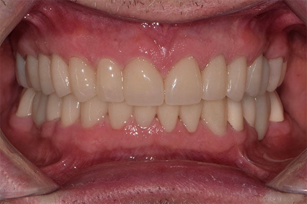 FMR1-after Full Mouth Rehabilitation after smile